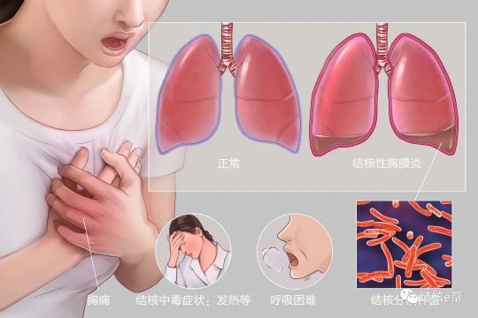 结核性胸膜炎是一种慢性疾病,也是由结核分枝杆菌引起的一种炎症,可能